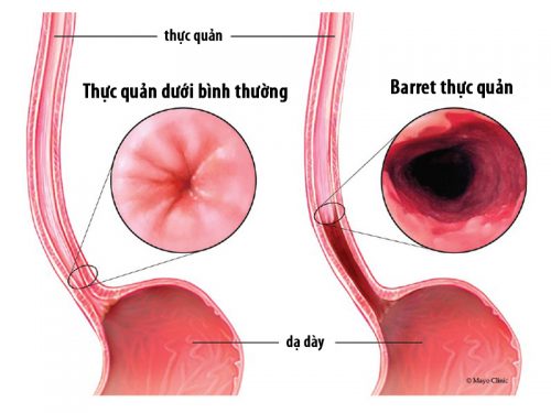 Biến chứng trào ngược dạ dày nguy hiểm bạn cần cảnh giác