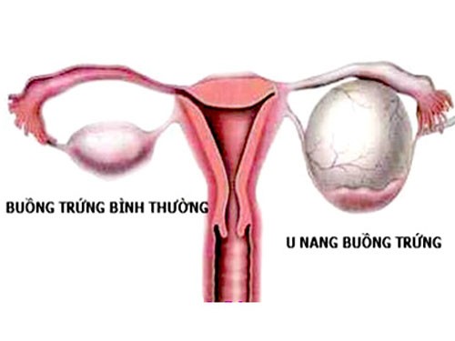 Biến chứng u nang buồng trứng cần biết hiện nay