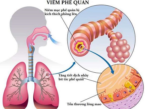 Biến chứng viêm phế quản cấp tiến triển thành mạn tính