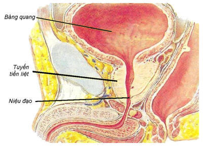 Biến chứng viêm tiền liệt tuyến