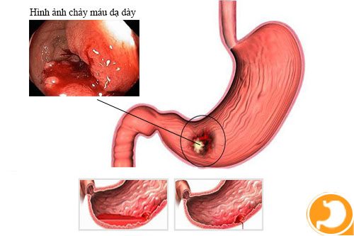 Biến chứng xuất huyết tiêu hóa