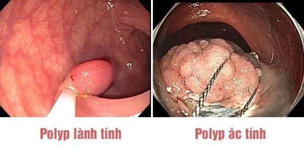 Biện pháp hiệu quả phòng ngừa polyp đại tràng tái phát