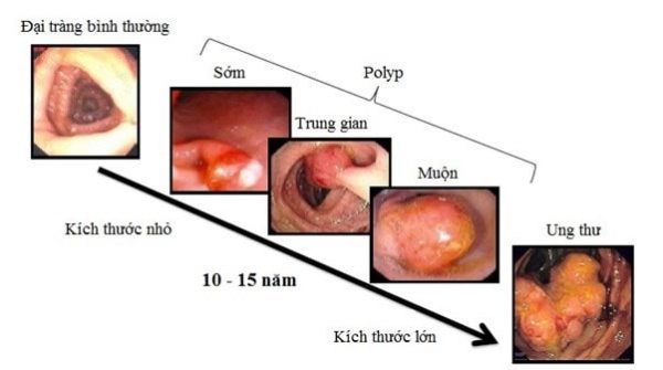 Biện pháp hiệu quả phòng ngừa polyp đại tràng tái phát