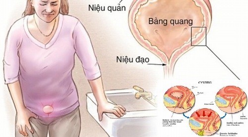 Biện pháp phòng ngừa nhiễm trùng đường tiểu