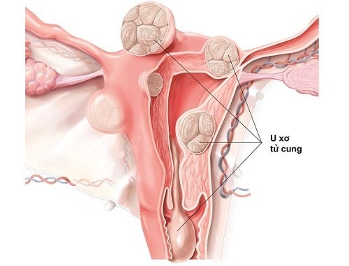 Biện pháp phòng ngừa u xơ tử cung