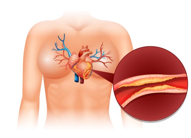 Biểu hiện bệnh mạch vành và cách phòng ngừa