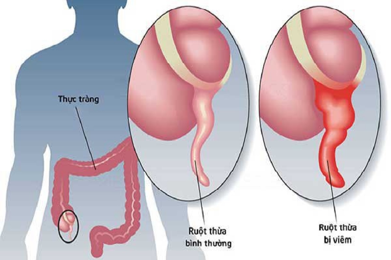 Biểu hiện bệnh ruột thừa cần điều trị ngay