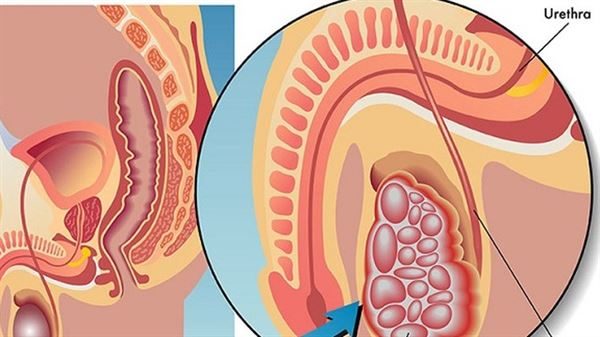 Biểu hiện bệnh ung thư tinh hoàn và cách điều trị tốt nhất