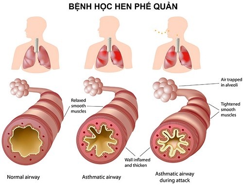 Biểu hiện của bệnh hen phế quản