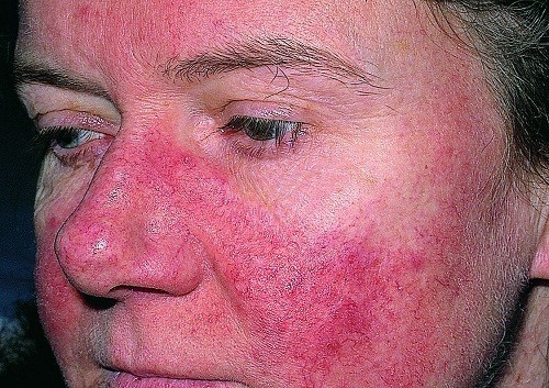 Biểu hiện của bệnh lupus ban đỏ