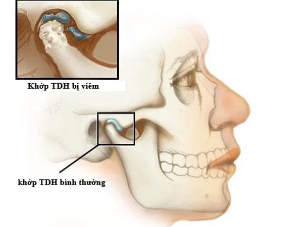 Biểu hiện của bệnh viêm khớp thái dương hàm