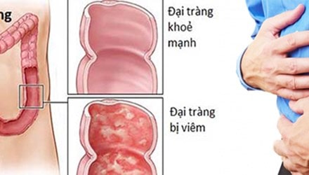 Biểu hiện của đau đại tràng, đọc sớm để kịp thời xử lý