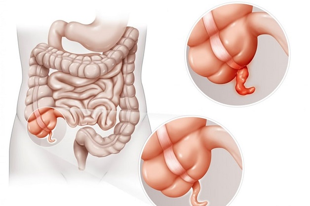 Biểu hiện của đau ruột thừa bạn cần biết