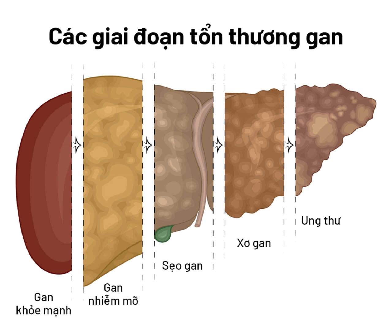 Biểu hiện của gan nhiễm mỡ, nguyên nhân và cách phòng tránh