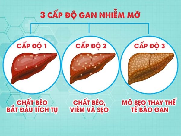 Biểu hiện của gan nhiễm mỡ, nguyên nhân và cách phòng tránh