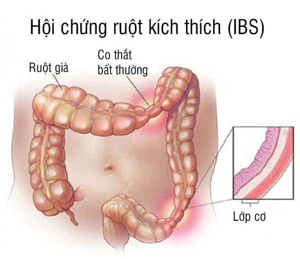 Biểu hiện của hội chứng ruột kích thích