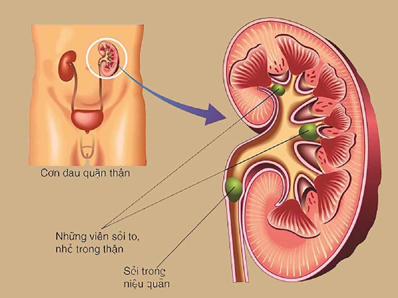 Biểu hiện của sỏi thận và cách xử trí hiệu quả