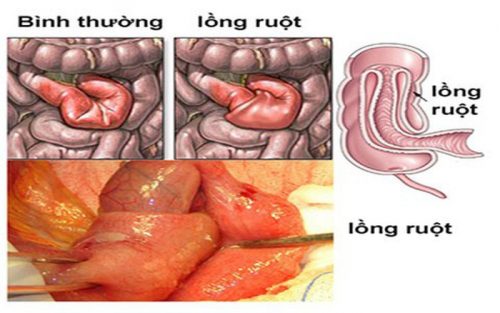 Biểu hiện của tắc ruột