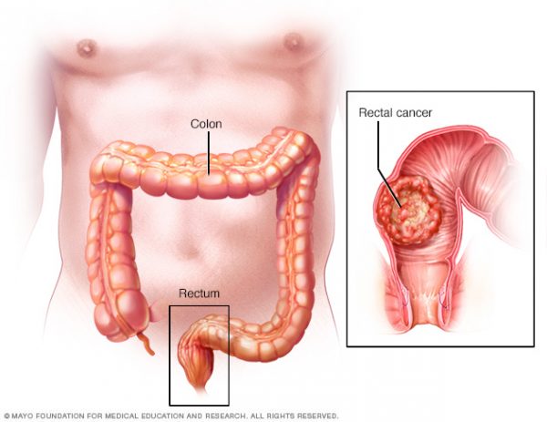 Biểu hiện của ung thư trực tràng giai đoạn cuối