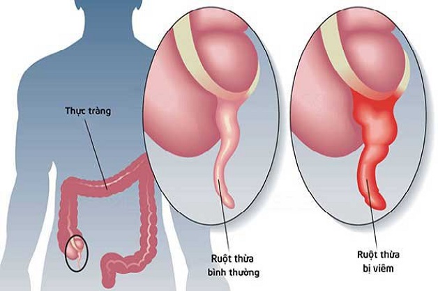 Biểu hiện của viêm ruột thừa cấp nhất định không được bỏ qua