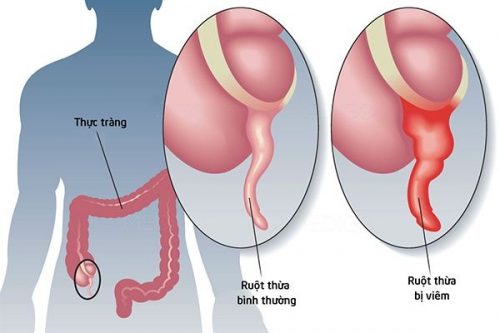 Biểu hiện của viêm ruột thừa cấp tính