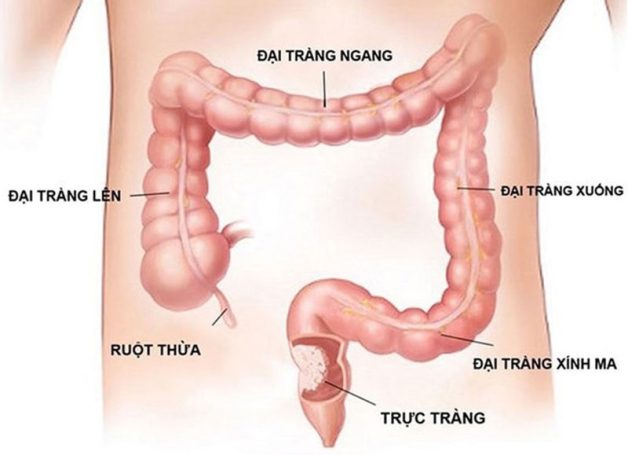 Biểu hiện đau đại tràng là gì? Đau đại tràng là đau ở đâu?