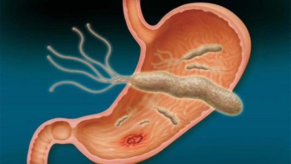 Biểu hiện loét dạ dày? Sẽ ra sao nếu mặc kệ các triệu chứng bệnh?