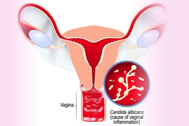 Biểu hiện nấm âm đạo và cách điều trị hiệu quả