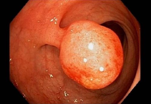 Biểu hiện polyp trực tràng