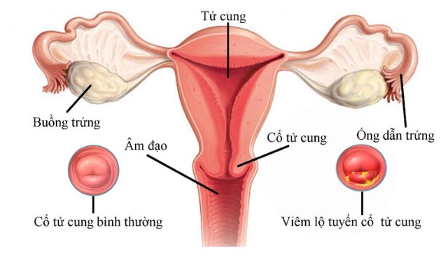 Biểu hiện sau đốt điện cổ tử cung mà người bệnh nên biết