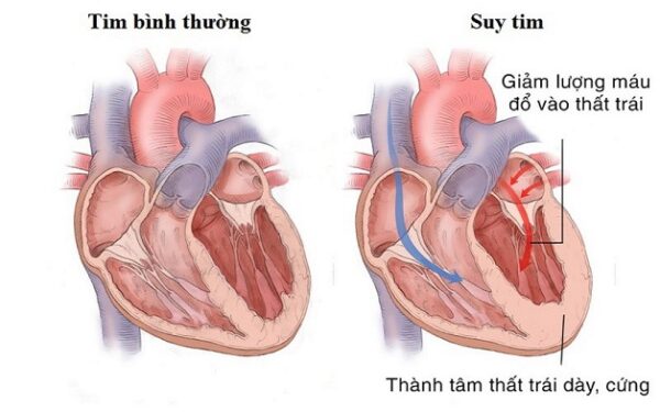 Biểu hiện suy tim và cách ngăn ngừa bệnh hiệu quả