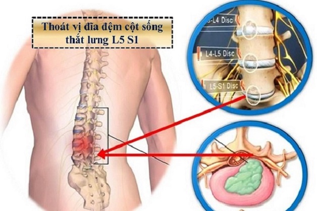 Biểu hiện thoát vị đĩa đệm ở hông, nguyên nhân và cách điều trị