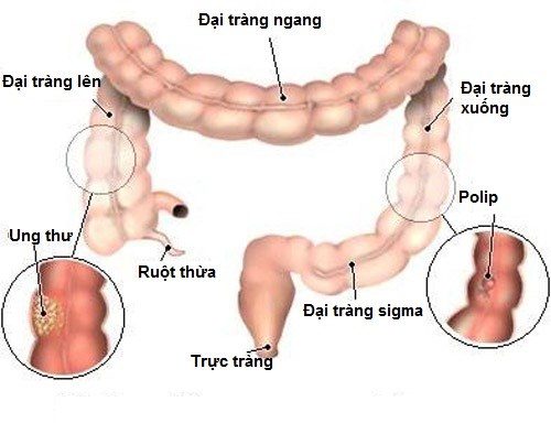 Biểu hiện ung thư đại tràng giai đoạn đầu