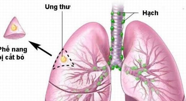 Biểu hiện ung thư phổi di căn hạch cổ