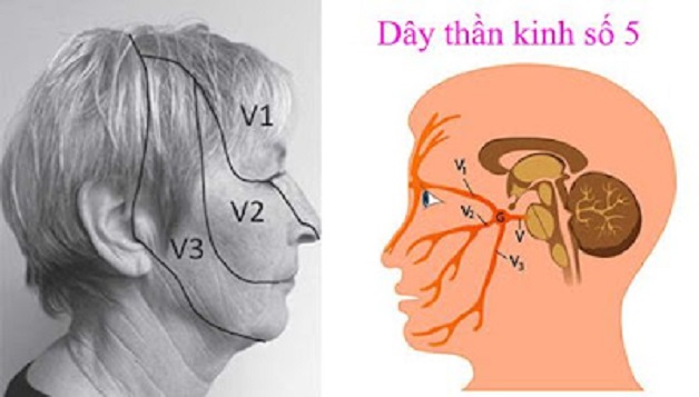 Biểu hiện viêm dây thần kinh số 5 và cách điều trị