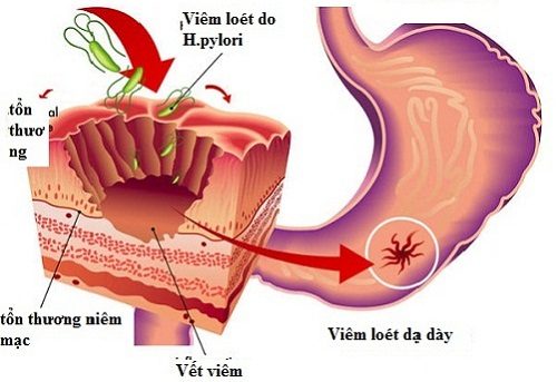 Biểu hiện viêm loét dạ dày tá tràng