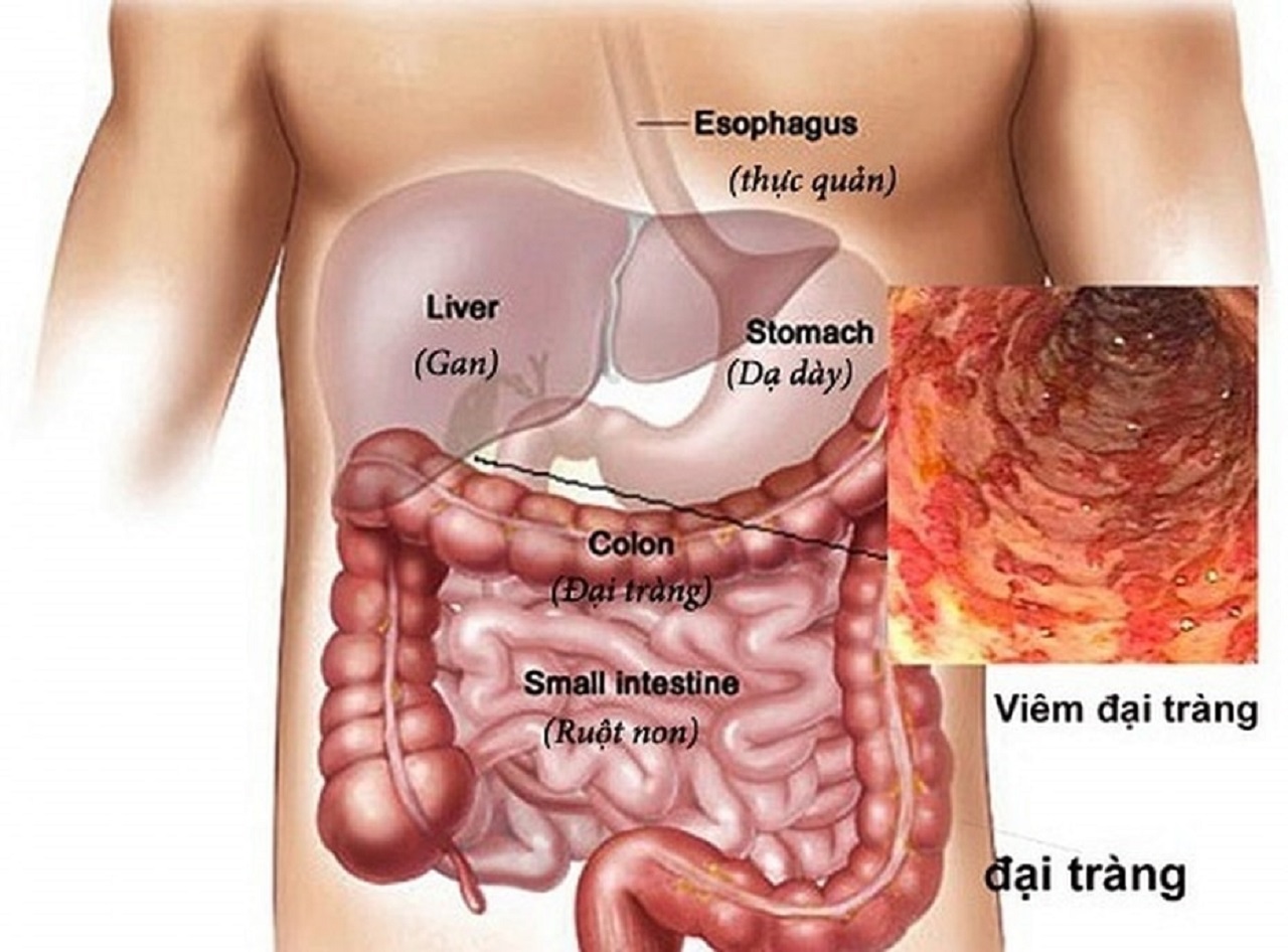 Biểu hiện viêm loét đại tràng