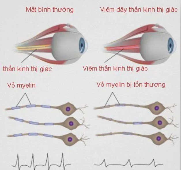 Biểu hiện viêm thần kinh thị giác và cách điều trị cơ bản