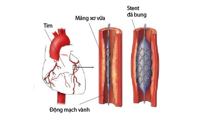 Bỏ thuốc lá làm giảm nguy cơ mắc bệnh động mạch vành