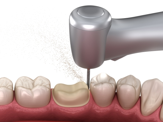 Bọc răng sứ có đau không và cách hạn chế đau nhức