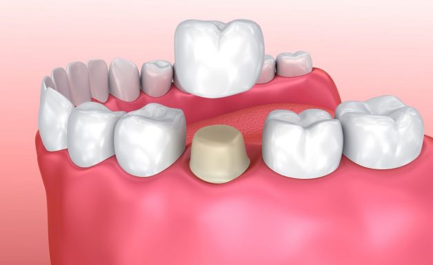 Bọc răng sứ là gì? Quy trình bọc răng sứ diễn ra như thế nào?