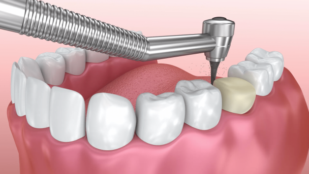 Bọc sứ răng hàm có phải giải pháp tối ưu để điều trị bệnh lý không?