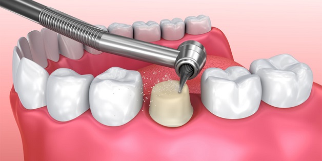 Bọc sứ răng hàm: những điều cần biết