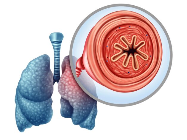 Bốn giai đoạn của bệnh phổi tắc nghẽn mạn tính COPD