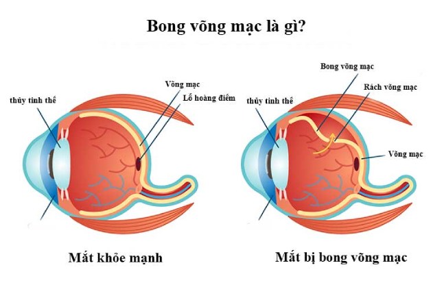 Bong võng mạc mắt trái có thể gây mất thị lực vĩnh viễn