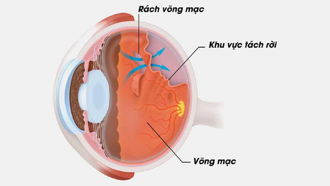 Bong võng mạc: Nguyên nhân và phương pháp điều trị