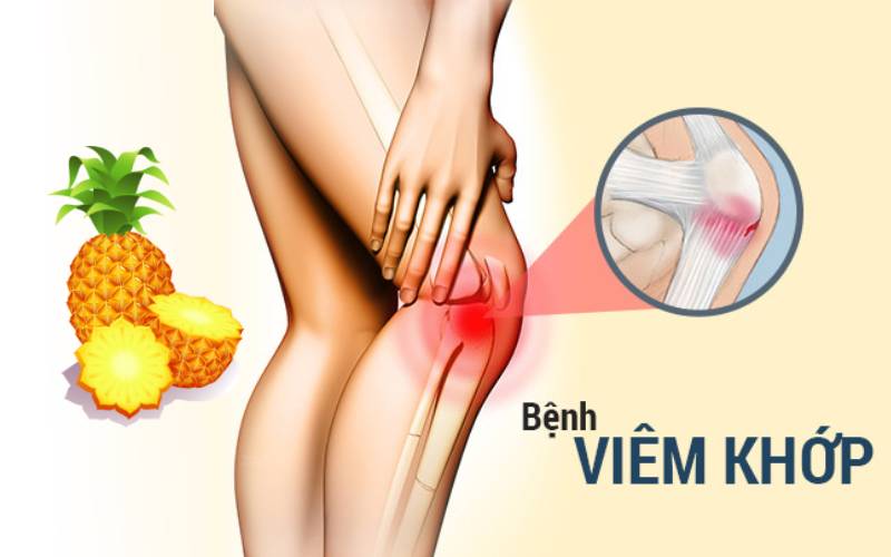 Bromelain – Thông tin thuốc và những lưu ý khi sử dụng