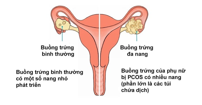 Buồng trứng có nhiều nang nhỏ có mang thai được không?