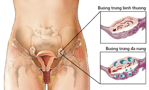 Buồng trứng đa nang là gì?nhiều chị em có thể mắc phải