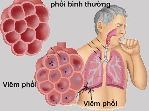 Các bệnh lây qua đường hô hấp dễ mắc